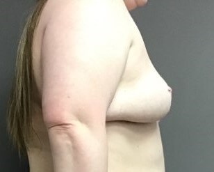 Side Before