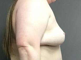 Side Before
