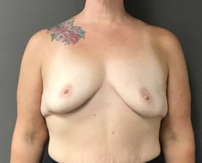 Anterior Before