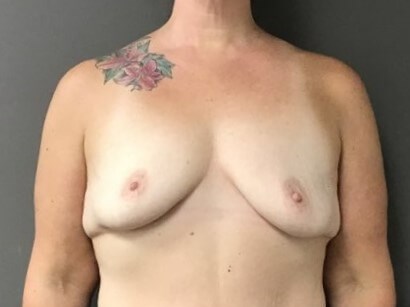 Anterior Before