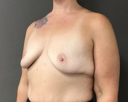 Oblique Before