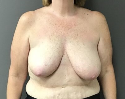 Anterior Before
