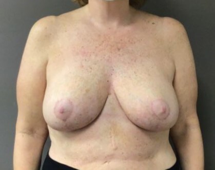 Anterior After