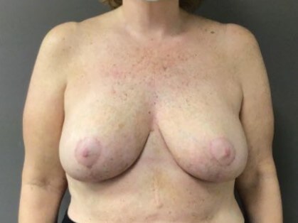 Anterior After