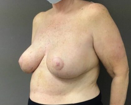 Oblique After