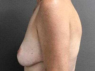 Side Before