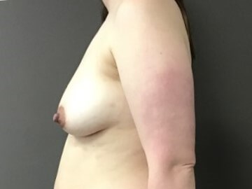 Side Before