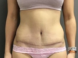 Anterior After
