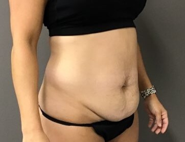 Oblique Before