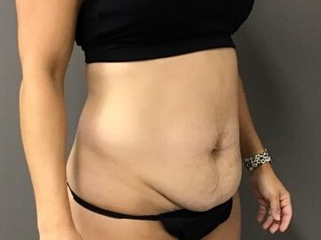 Oblique Before