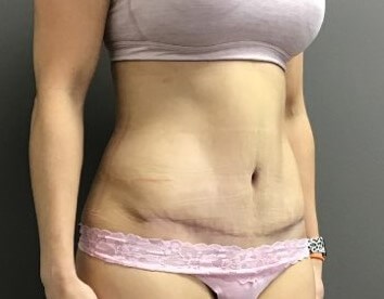 Oblique After