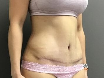 Oblique After