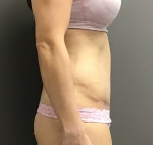 Side After