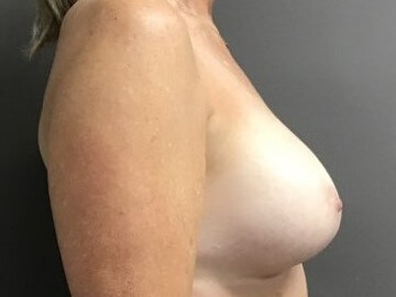 Side After