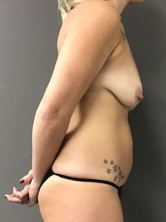 Side Before