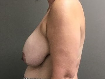 Side Before