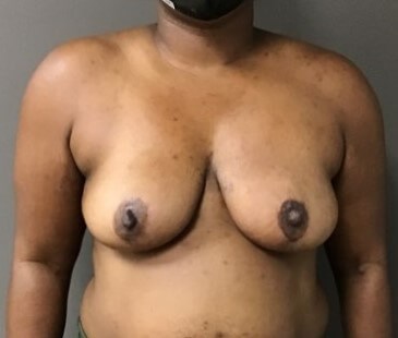Anterior After