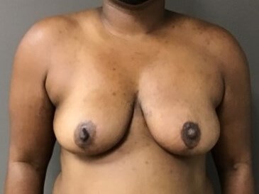 Anterior After