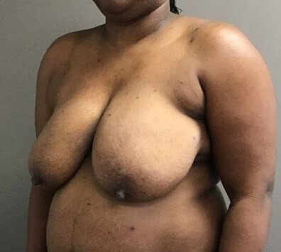 Oblique Before
