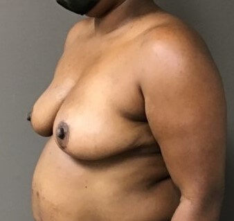 Oblique After