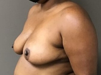 Oblique After