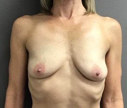 Anterior Before