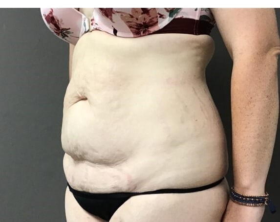 Oblique Before