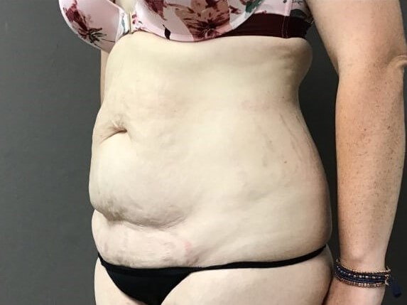 Oblique Before