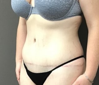 Oblique After