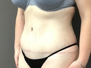 Oblique After