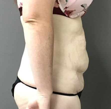 Side Before
