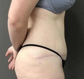 Side After