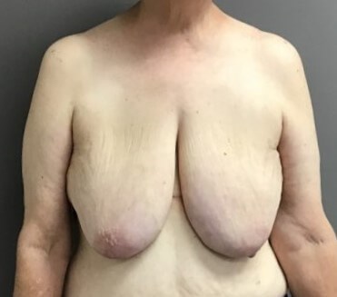 Anterior Before