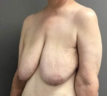 Oblique Before