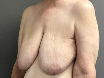 Oblique Before