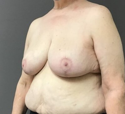 Oblique After