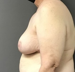 Side After