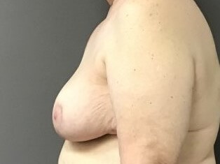 Side After
