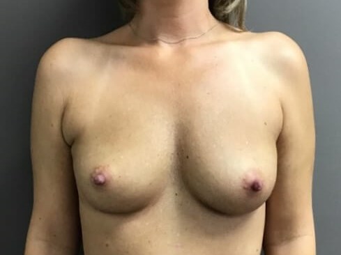 Anterior Before