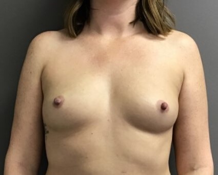 Anterior Before