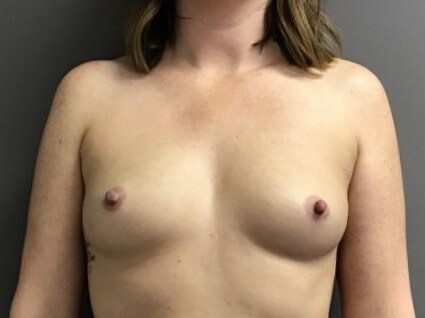 Anterior Before