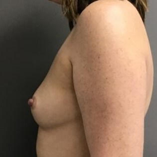 Side Before