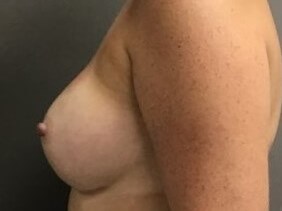 Side After