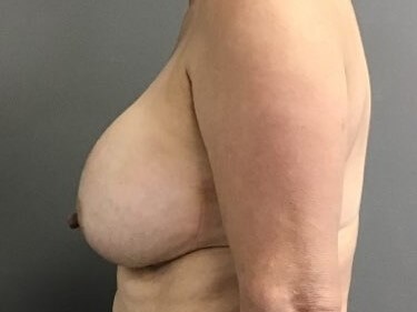 Side Before