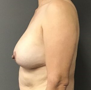 Side After