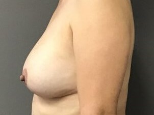 Side After