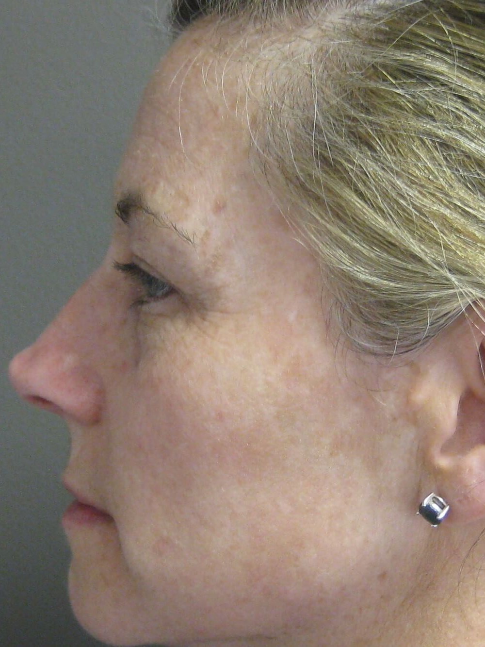 Side After