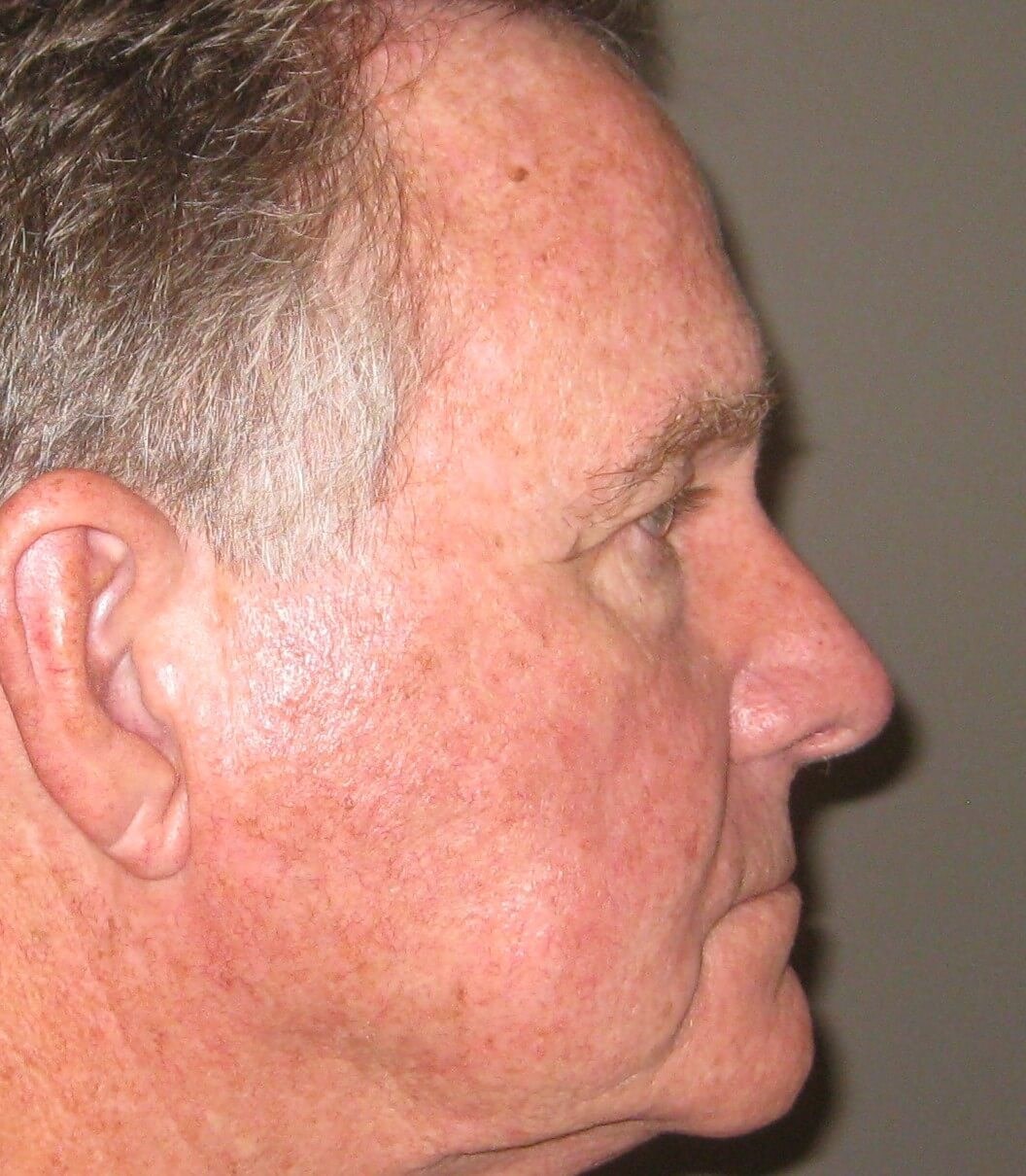 Side After