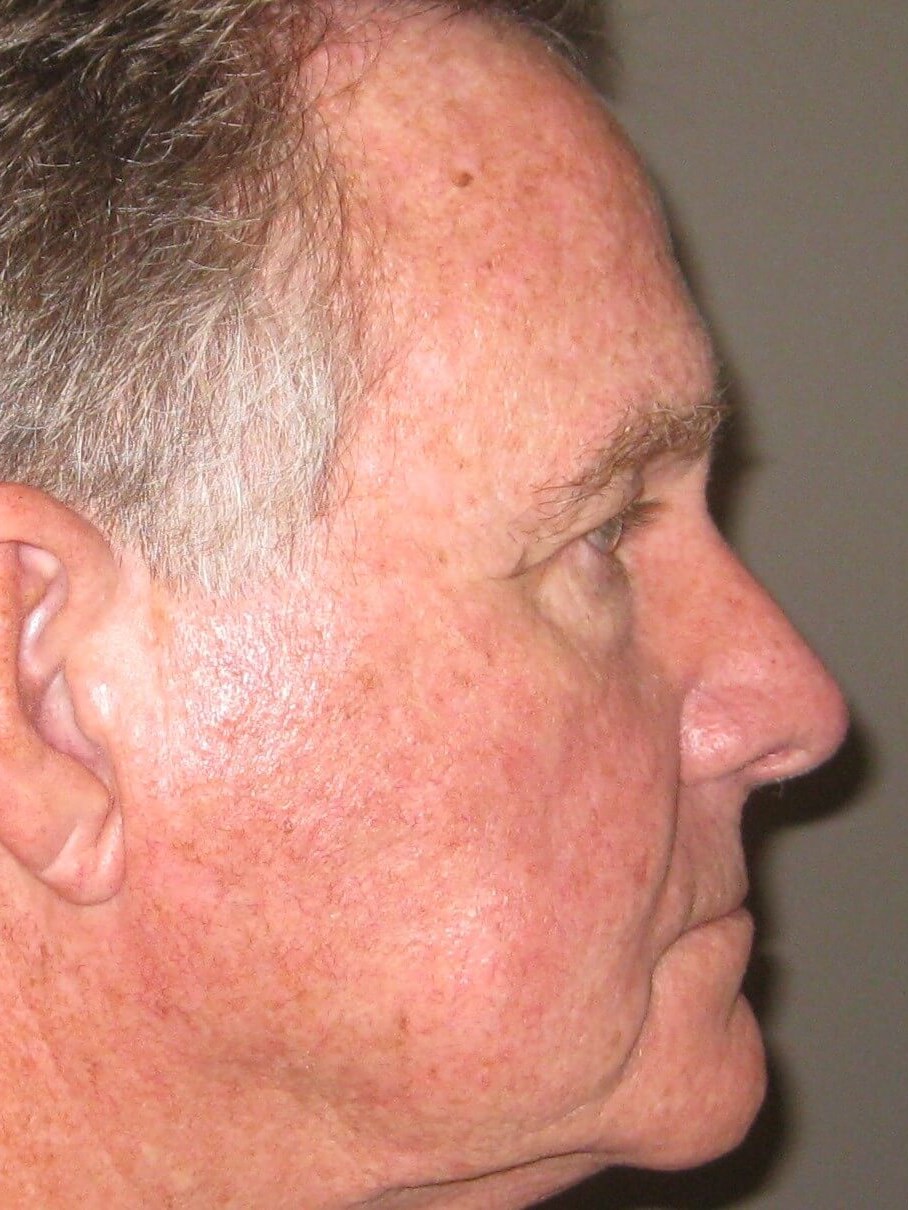 Side After