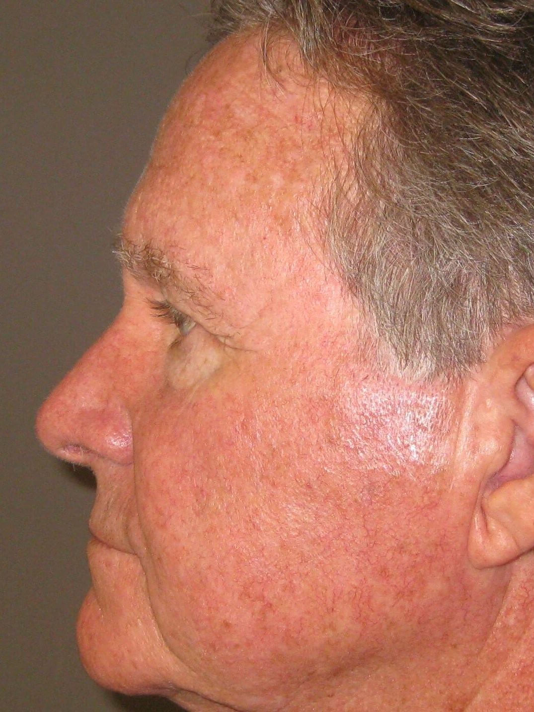 Side After